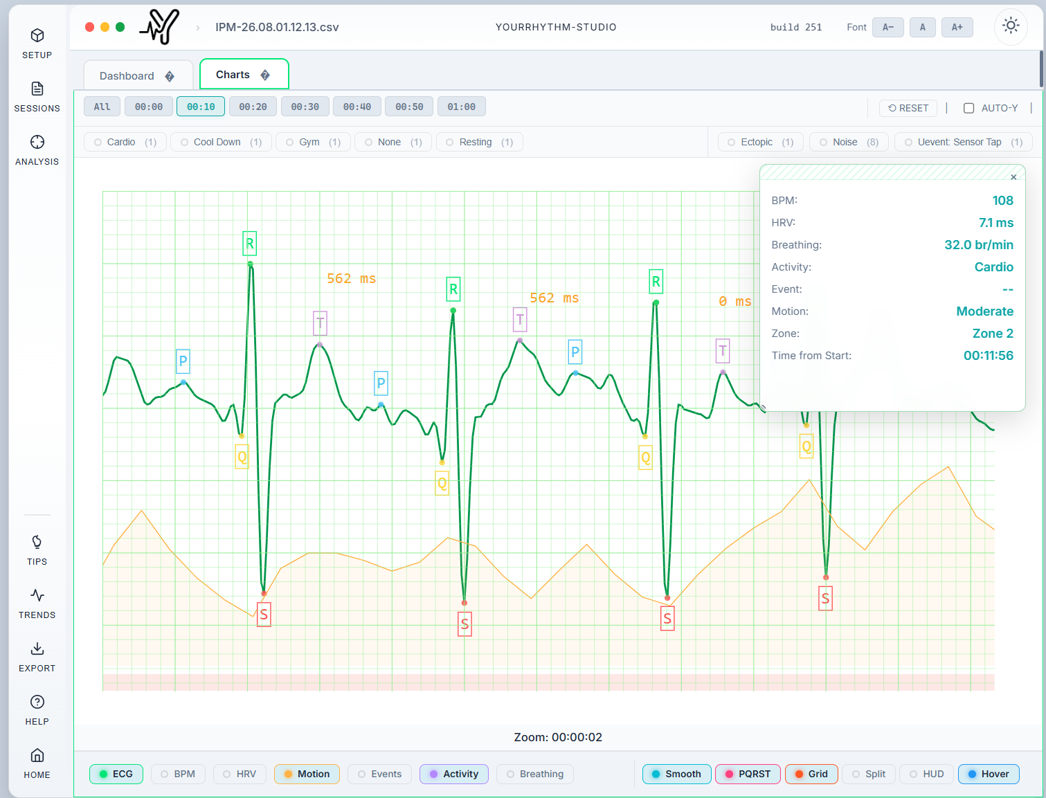 Zoomed ECG with PQRST wave annotation